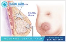 Dấu hiệu bệnh ung thư vú? Nguyên nhân và cách điều trị hiệu quả