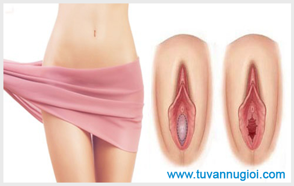 Vá màng trinh giúp mang đến sự tự tin cho chị em phụ nữ