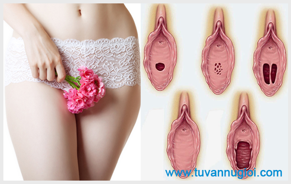 5 Câu Hỏi Liên Quan Đến Vấn Đề Vá Màng Trinh Bạn Cần Biết