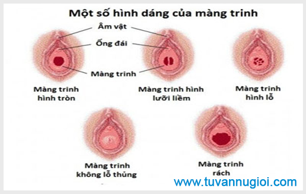 Nhu cầu vá màng trinh ngày càng phổ biến hơn