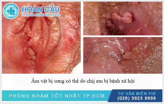 Âm vật có thể do bị bệnh sùi mào gà