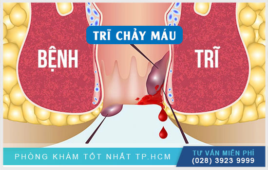bac-si-chuyen-khoa-giai-dap-nhung-thac-mac-thuong-gap-khi-bi-tri2.jpg