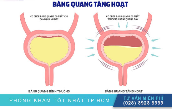Triệu chứng bàng quang tăng hoạt Bang-quang-tang-hoat-la-gi-dieu-tri-nhu-the-nao