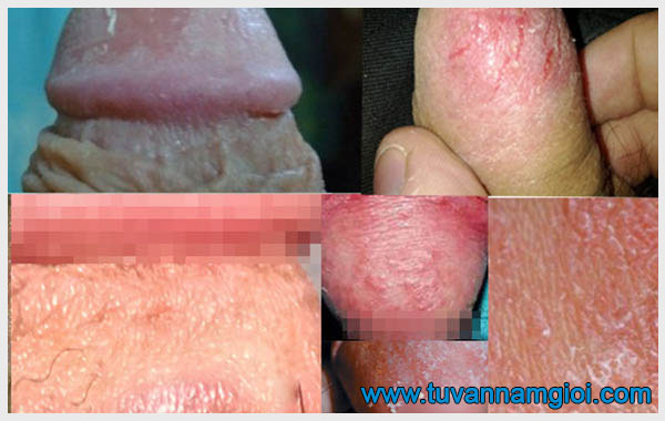 Da bao quy đầu bị khô có thể do các bệnh nam khoa nguy hiểm
