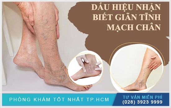 Bệnh giãn tĩnh mạch chân và phương pháp phòng ngừa Benh-gian-tinh-mach-chan-va-nhung-dieu-can-biet