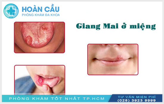 Bệnh giang mai ở miệng: Nguyên nhân, triệu chứng và cách điều trị