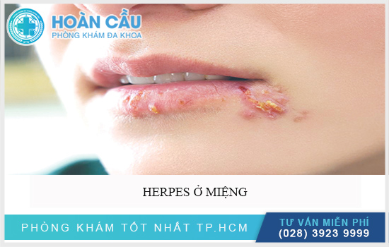 Bệnh Herpes gây nhiều ảnh hưởng