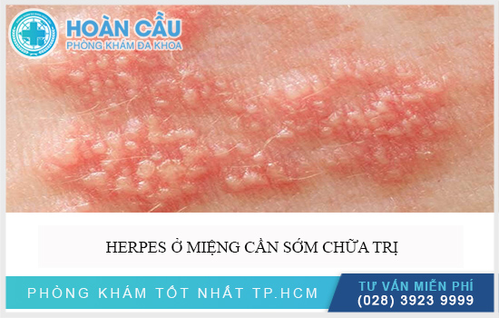 Bệnh Bệnh Herpes gây nhiều ảnh hưởng gây nhiều biến chứng