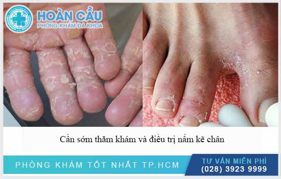 Cần sớm thăm khám và chữa nấm kẽ chân