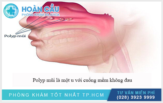 Có nhiều người bị bệnh polyp mũi