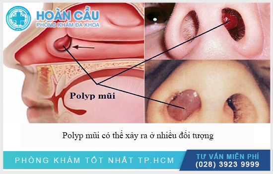 Polyp mũi có thể xảy ra ở nhiều đối tượng khác nhau