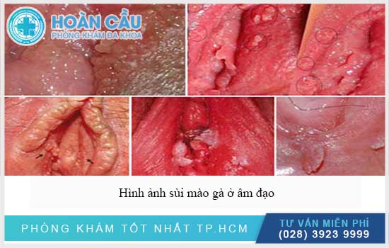 Hình ảnh của sùi mào gà ở âm đạo