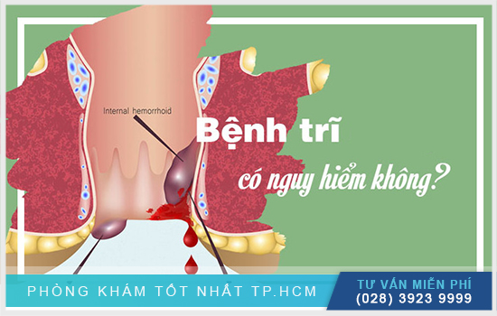 [TP.HCM] Bệnh trĩ có nguy hiểm không? Làm gì nếu bị bệnh trĩ?