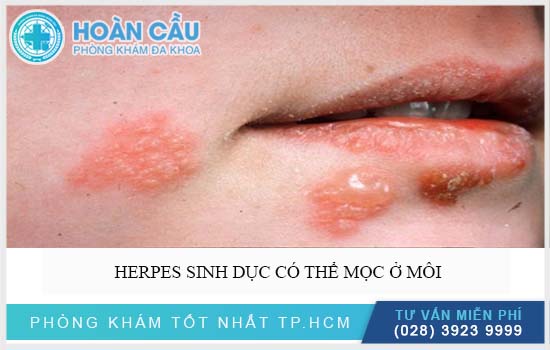 Bệnh Herpes simplexcó thể mọc ở môi