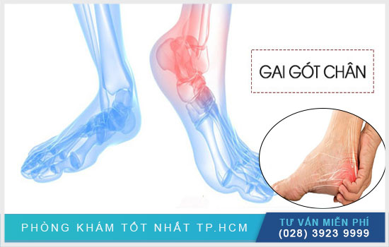 Bị gai gót chân: dấu hiệu và cách chữa trị  [TPHCM - Bình Dương - Đồng Nai - Long An - Tiền Giang]