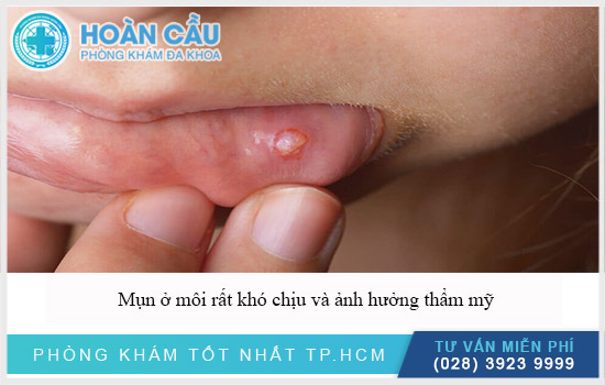 Mụn ở môi gây cảm giác cực kỳ khó chịu