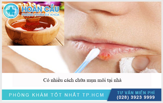 Có nhiều cách dân gian chữa mụn môi