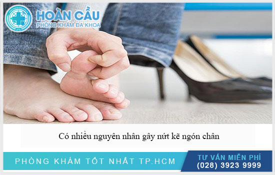 Có nhiều nguyên nhân gây nứt kẽ ở ngón chân