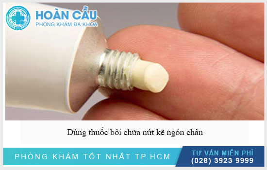 Có thể dùng thuốc bôi chữa nứt kẽ ở ngón chân