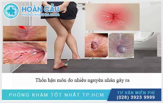 Thốn hậu môn do nhiều nguyên nhân 