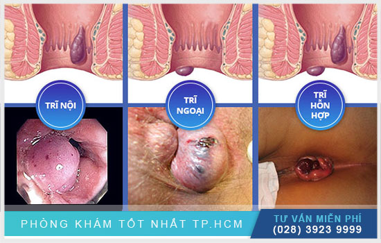 HCM - Bị trĩ không đơn giản như bạn nghĩ - nguy hiểm  Bi-tri-khong-don-gian-nhu-ban-van-nghi1