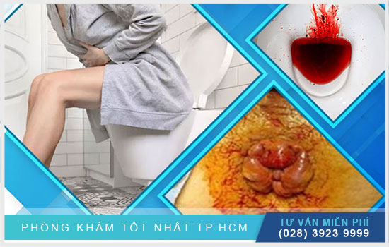 HCM - Bị trĩ không đơn giản như bạn nghĩ - nguy hiểm  Bi-tri-khong-don-gian-nhu-ban-van-nghi2