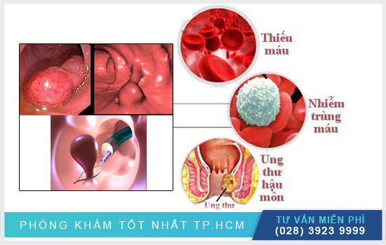 Những biến chứng của bệnh Polyp hậu môn