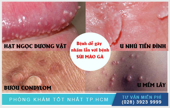 Các bệnh dễ nhầm lẫn với sùi mào gà Cac-benh-de-nham-voi-sui-mao-ga-co-the-ban-chua-biet1(1)