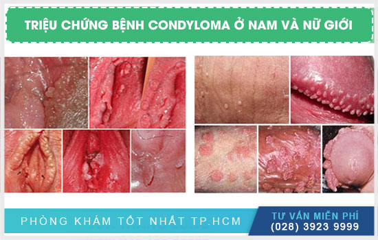 triệu chứng bệnh Condyloma ở nam và nữ giới