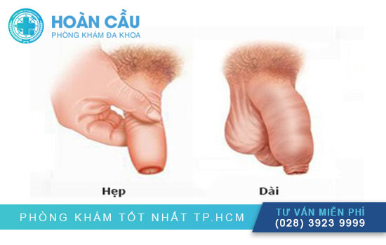 Đầu dương vật quá nhạy cảm do dài hoặc hẹp bao quy đầu