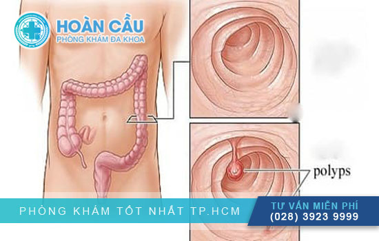 Polyp hậu môn