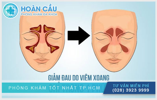 Cách giúp giảm đau do viêm xoang trán Cach-giam-dau-viem-xong-tran-2