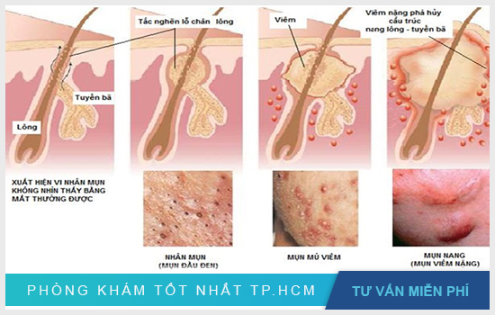 Hình ảnh mụn bọc dưới da