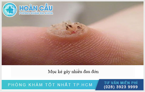 Mục ké sẽ gây nhiều đau đớn