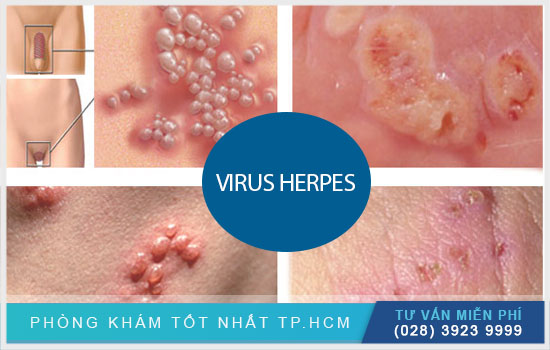 Cảnh báo: những ảnh hưởng virus Herpes đến thai kỳ [TPHCM - Bình Dương - Đồng Nai - Long An - Tiền Giang]