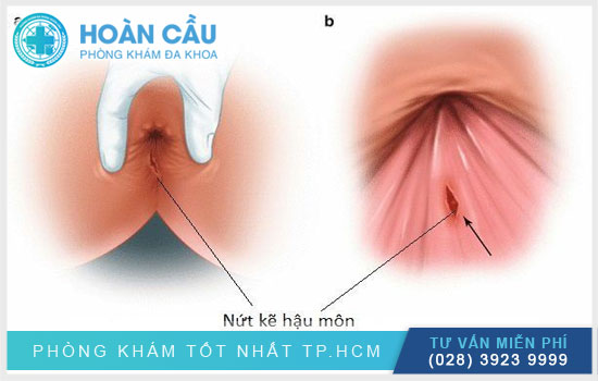 Đi cầu ra máu có thể bạn đã bị nứt kẽ hậu môn