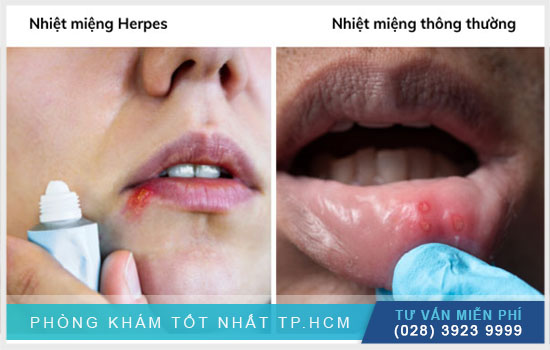 Chi tiết cách phân biệt nhiệt miệng và Herpes [TPHCM - Bình Dương - Đồng Nai - Long An - Tiền Giang]