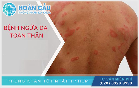 Bị ngứa da toàn thân là tình trạng nhiều người gặp phải