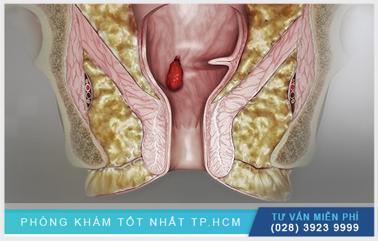 [TP.HCM] Danh sách phòng khám trĩ quận 8 uy tín