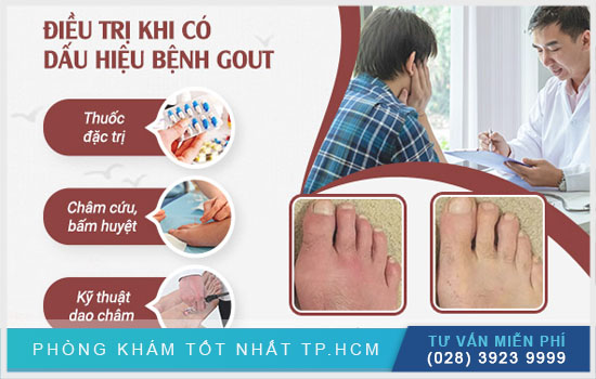 Điều trị khi có dấu hiệu bệnh Gout