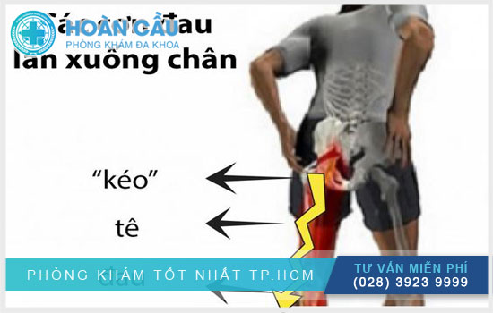 Triệu chứng đau dây thần kinh tọa