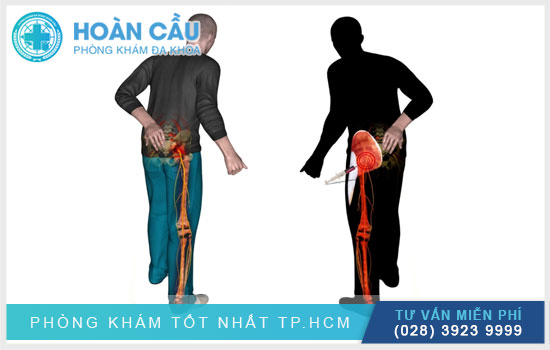 Đau thần kinh tọa - cần chữa trị sớm ngăn ngừa nguy cơ bại liệt