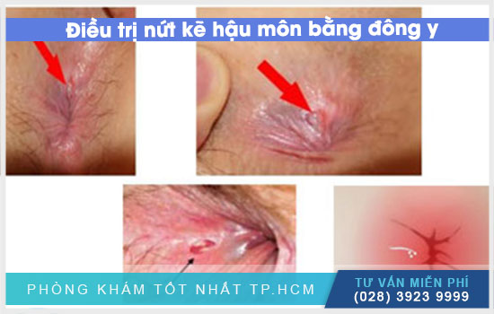 [TPHCM] Điều trị nứt kẽ hậu môn bằng thuốc đông y