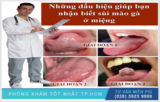 dưới lưỡi nổi hột có thể là do bị sùi mào gà