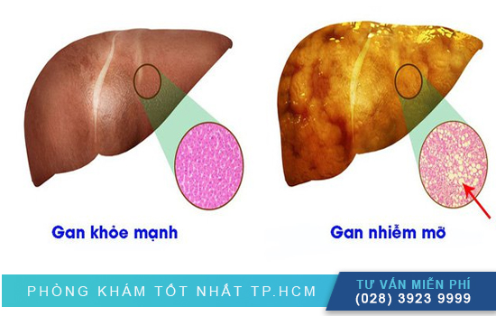 Gan nhiễm mỡ: Nguyên nhân, dấu hiệu nhận biết và cách chữa trị