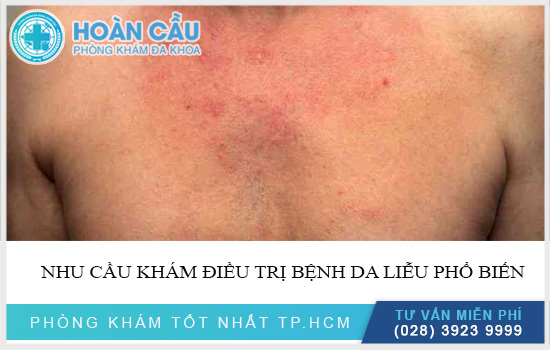 Gợi ý 5 địa chỉ bệnh viện da liễu Thủ Đức