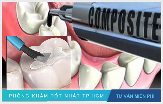 Hàn răng sâu: Giải pháp hiệu quả cho răng sâu Han-rang-sau-het-bao-nhieu-tien2
