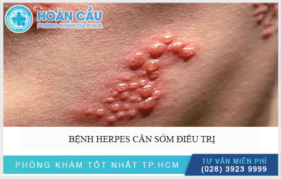 Cần sớm chữa bệnh Herpes