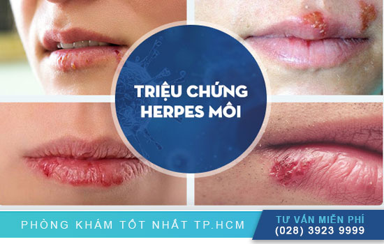 Herpes môi có để lại sẹo không Herpes-moi-co-de-lai-seo-khong-dieu-tri-nhu-the-nao