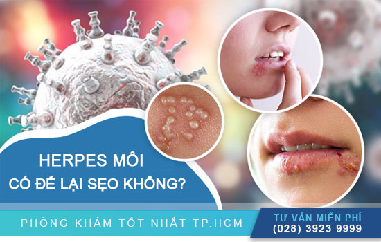 Herpes môi có để lại sẹo không? Điều trị như thế nào? [TPHCM - Bình Dương - Đồng Nai - Long An - Tiền Giang]